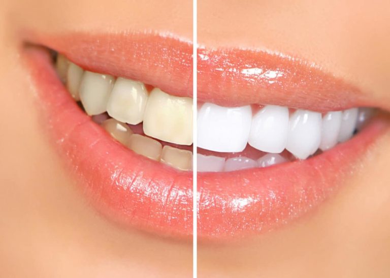 Teeth Whitening Phoenix Dentist