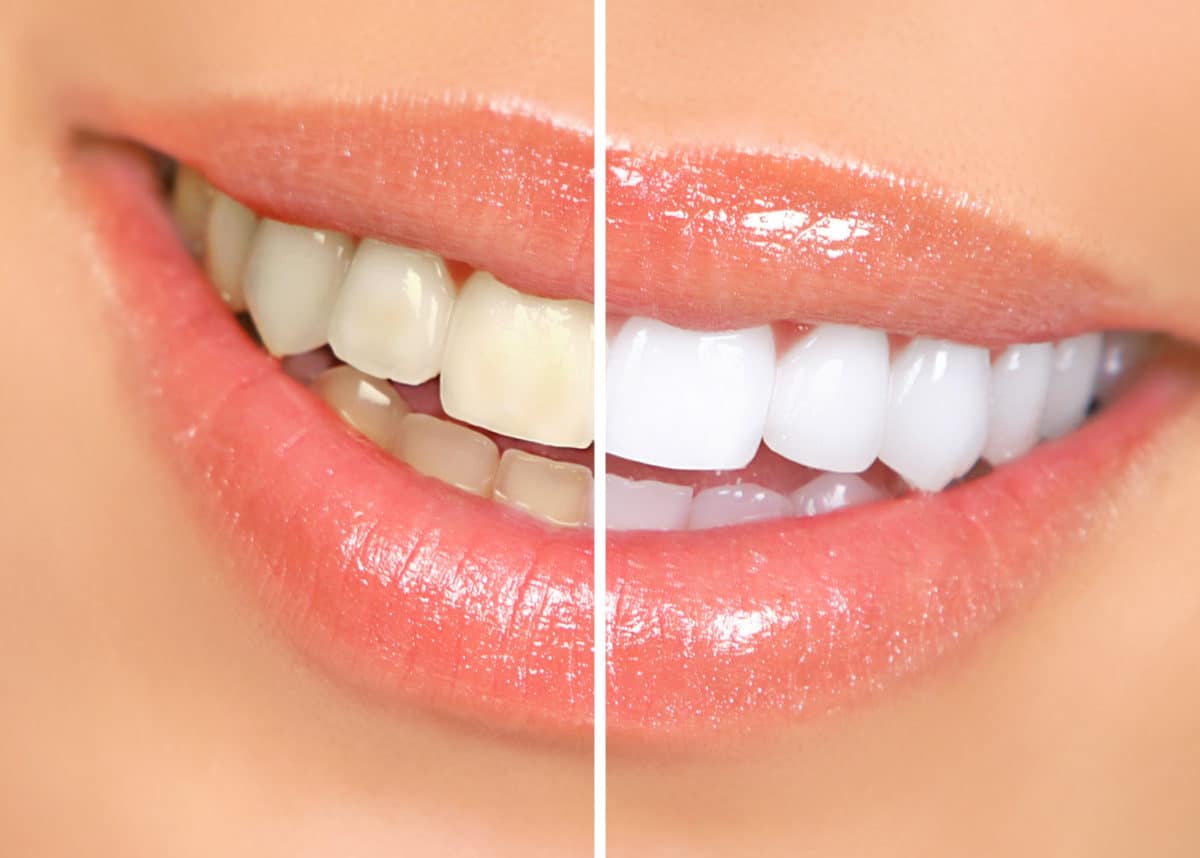 Phoenix Teeth Whitening Before and After image