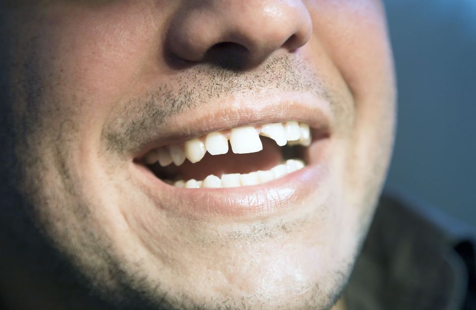 Man with broken tooth and will under go dental bonding
