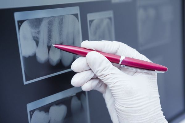 Xray of jawbone and implant