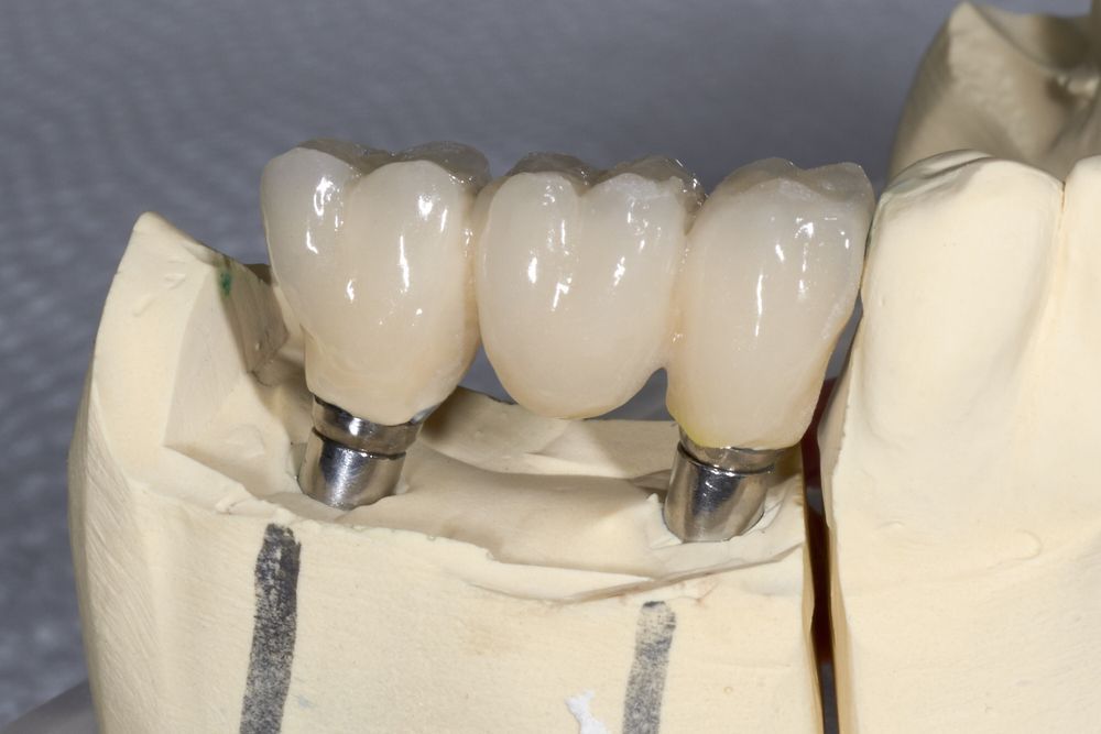 dental implant result